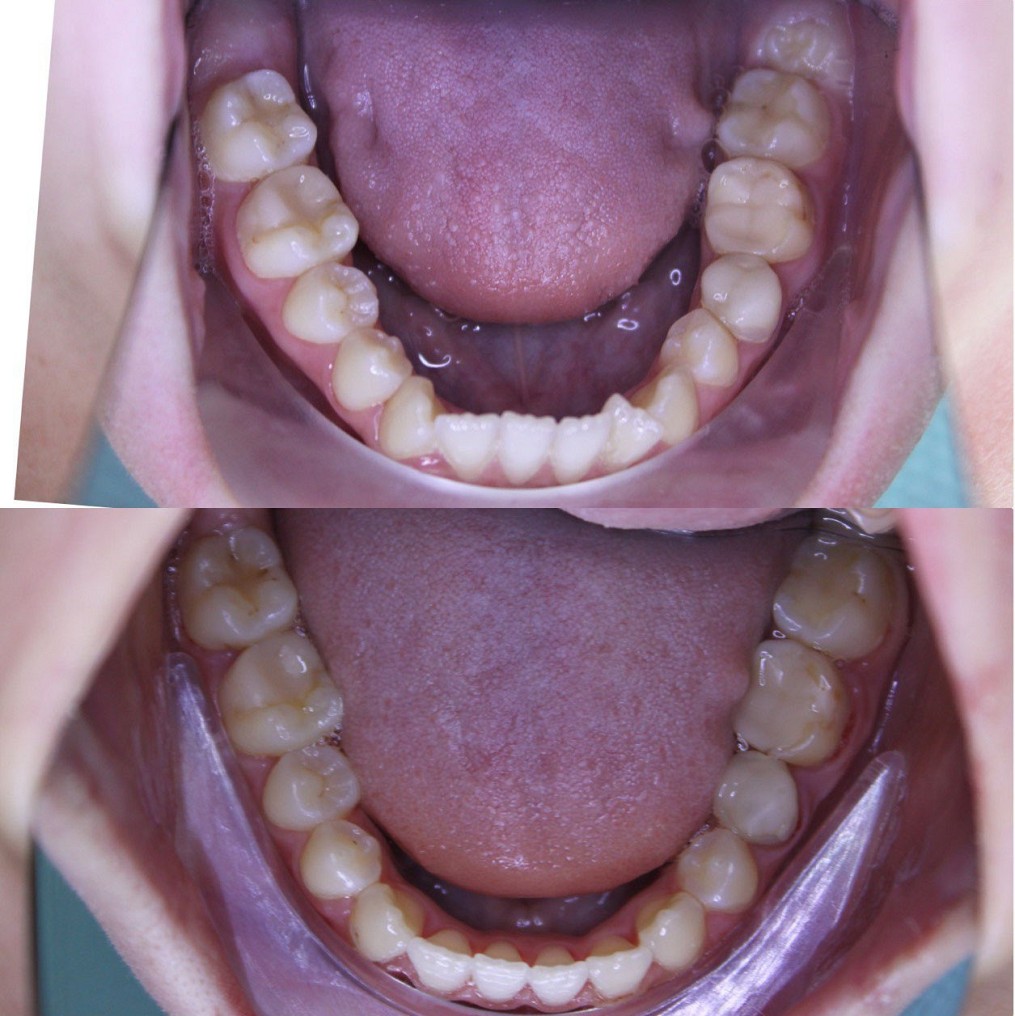 ортодонтыя до и после